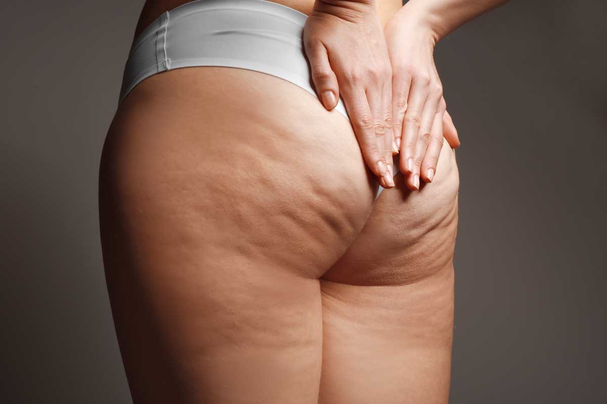 Victra-Cellulite-Bud