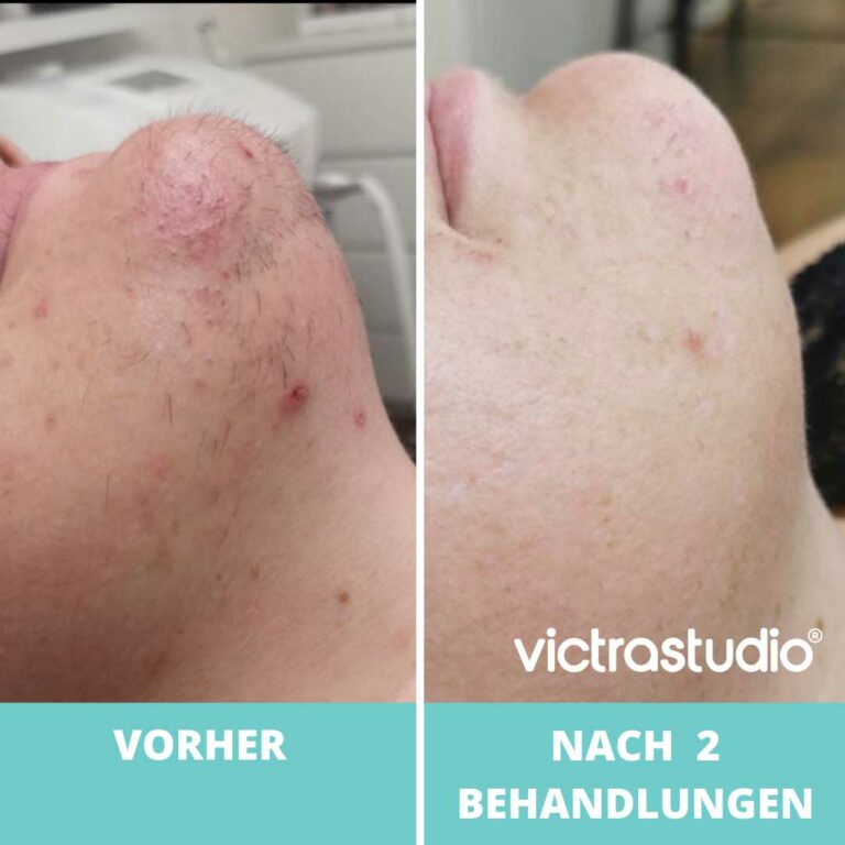 Dauerhafte Haarentfernung Victrastudio